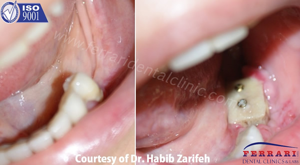 bone graft by Dr. Habib Zarifeh