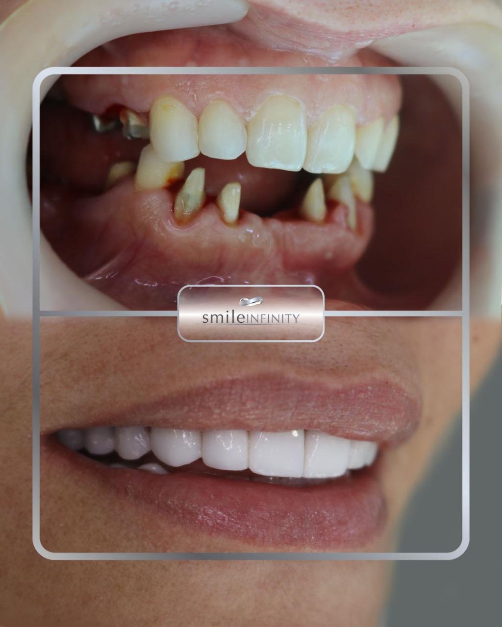 Bone graft with piezosurgery by Dr. Habib Zarifeh, Smile Infinity