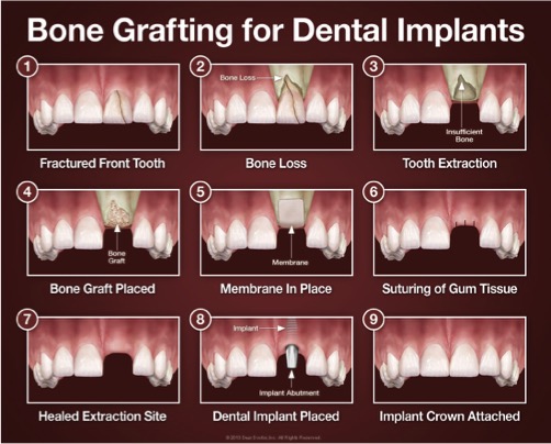 bone graft