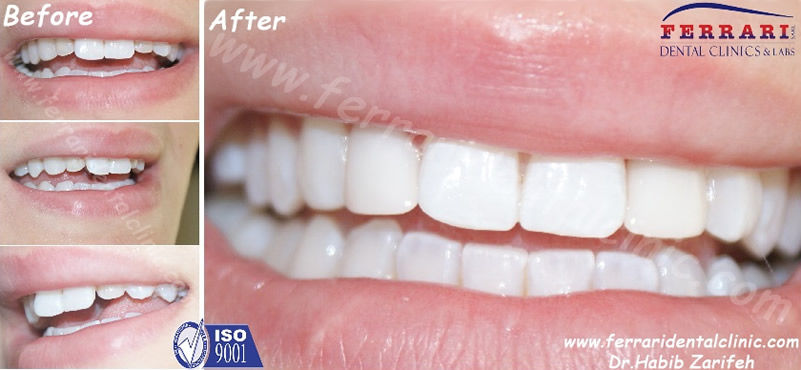 Composite veneers case by Dr. Habib Zarifeh. Beirut - Lebanon