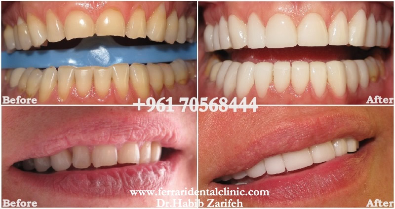 Composite veneers case by Dr. Habib Zarifeh