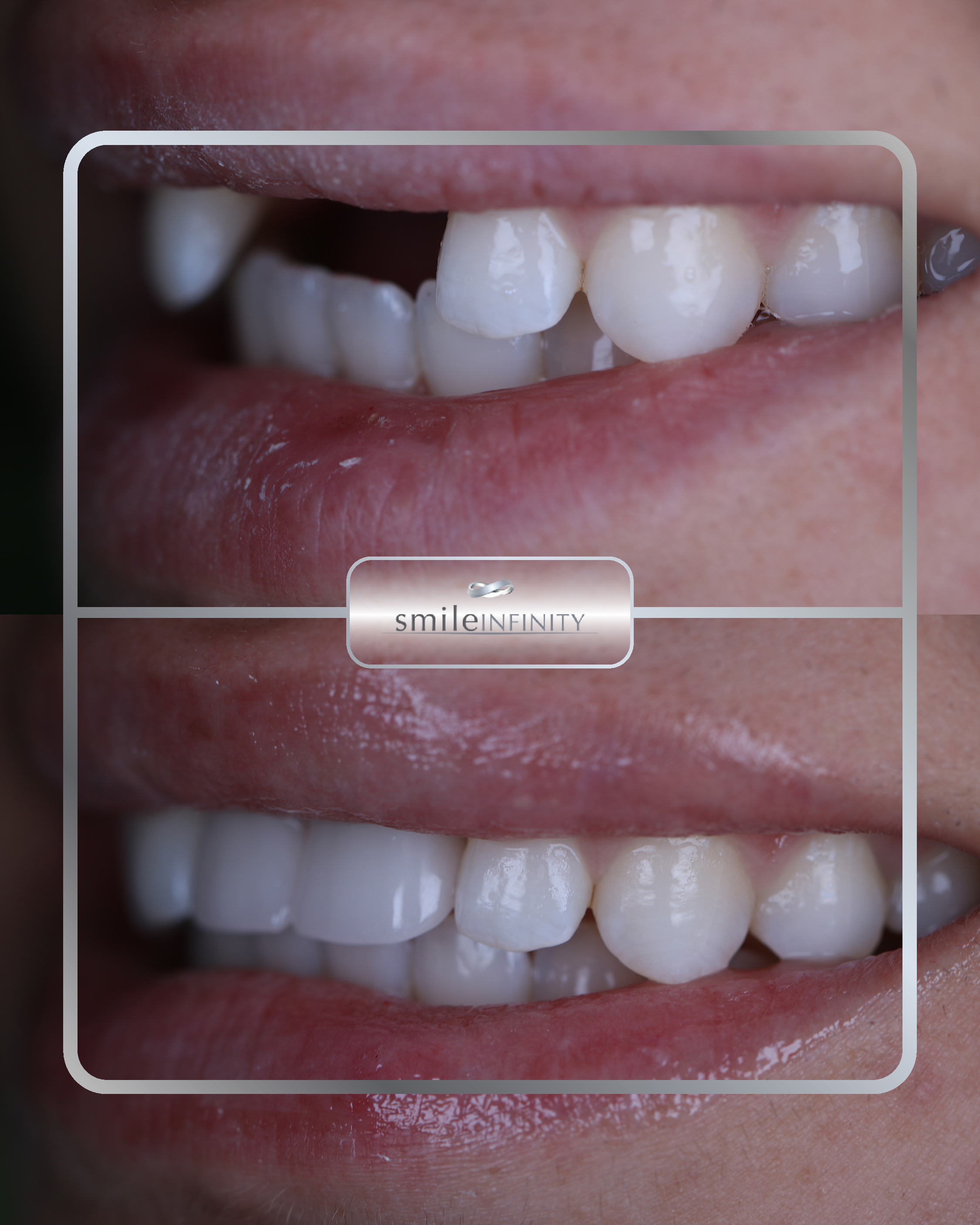 All-on-4 and All-on-6 dental implants, Smile Infinity Lebanon
