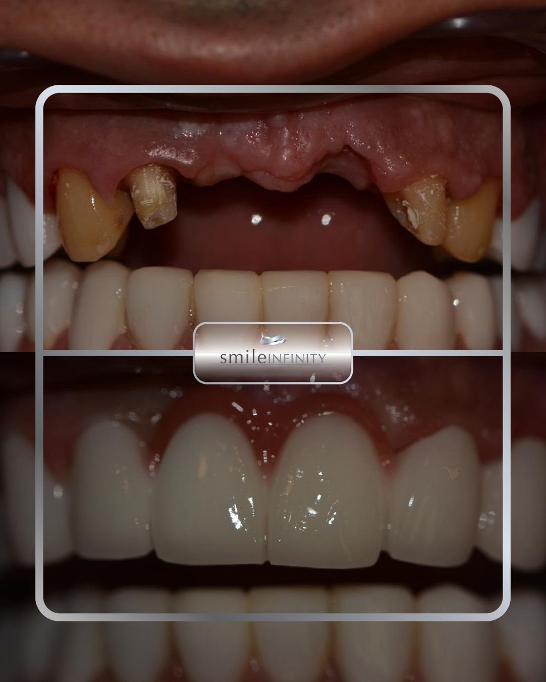 Flapless dental implant surgery with Erbium laser, Dr. Habib Zarifeh