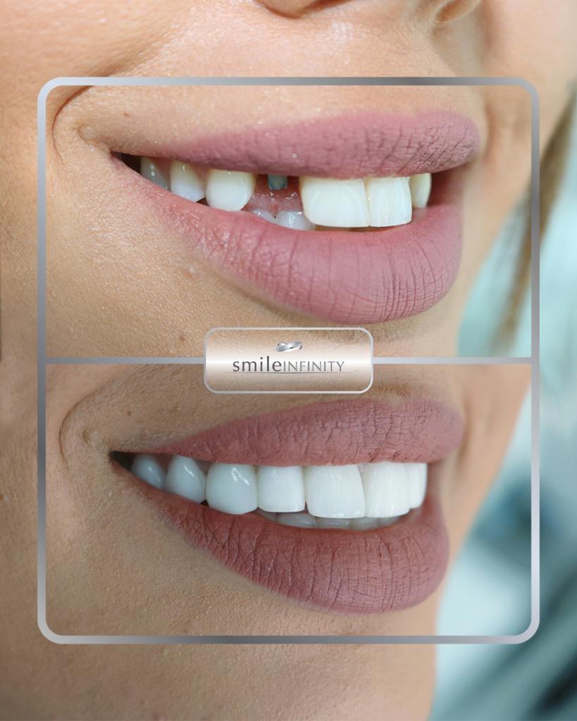 German-quality dental implants by Dr. Habib Zarifeh, Beirut Lebanon