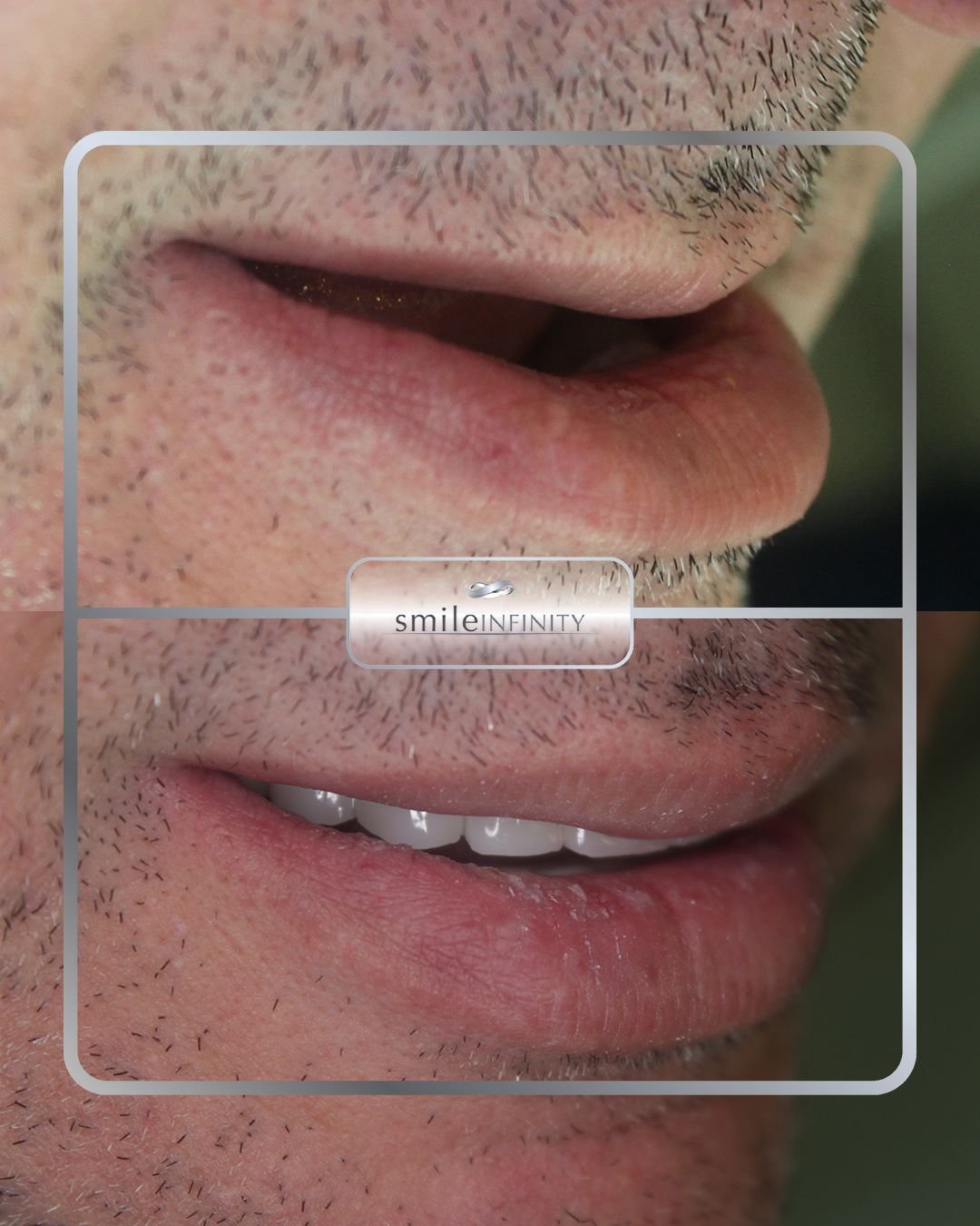 Piezosurgery for dental implants, Smile Infinity Beirut Lebanon
