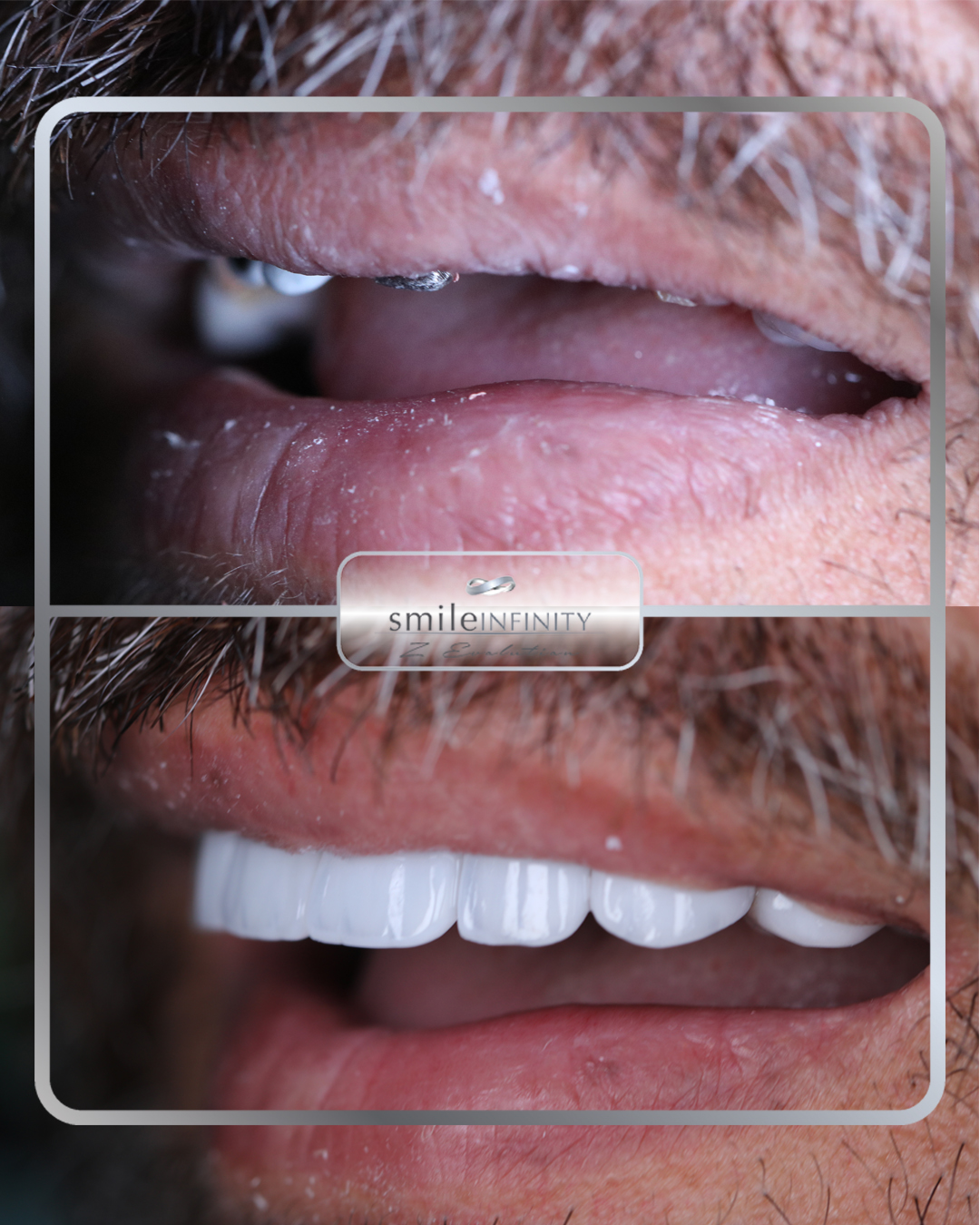 Smile Lift with dental implants and veneers, Dr. Habib Zarifeh Lebanon