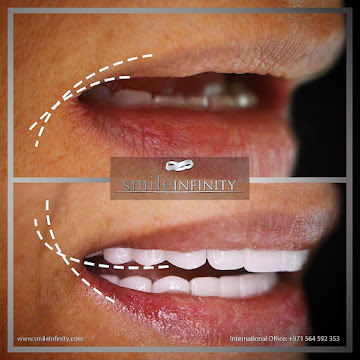 Zirconia implant bridge result, Smile Infinity Lebanon