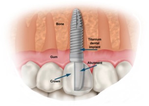 dental implants