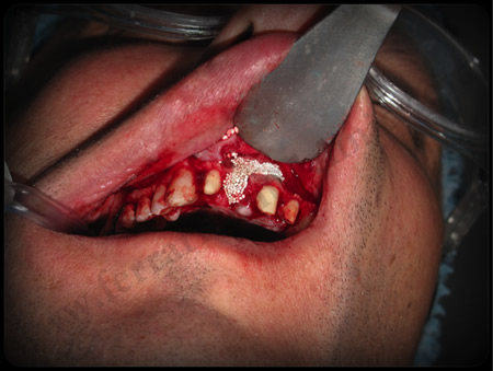 gum graft by Dr. Habib Zarifeh - Lebanon