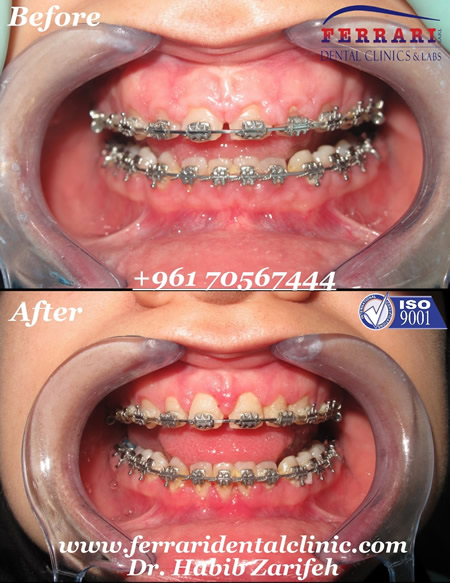 gummy smile case by Dr. Habib Zarifeh