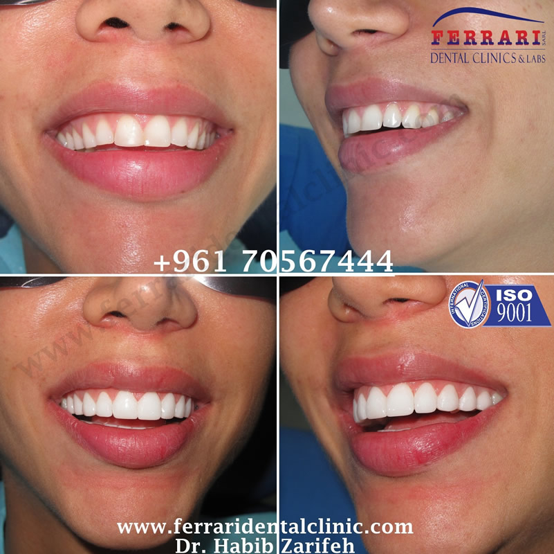 hollywood smile case done by Dr. Habib Zarifeh. Beirut - Lebanon