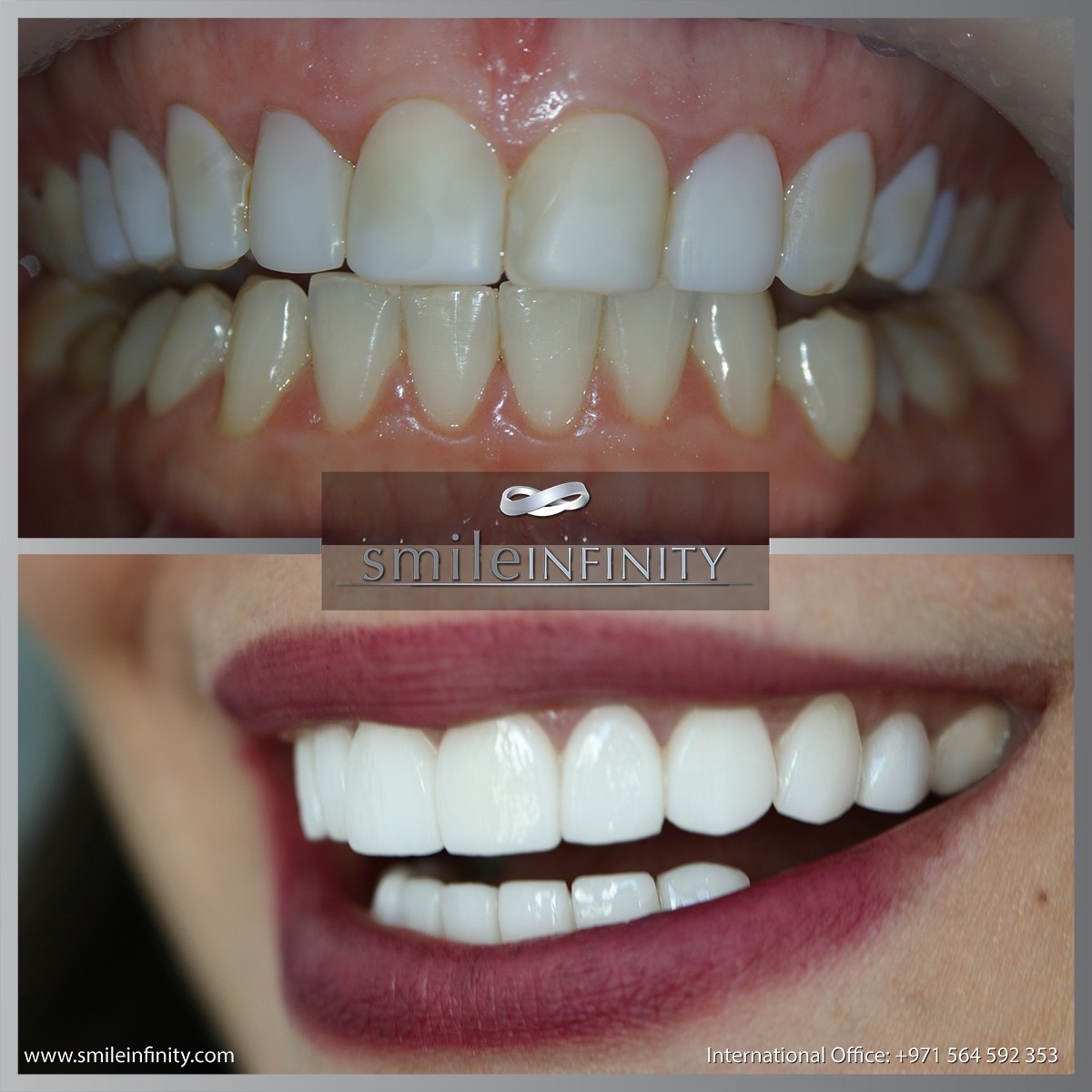 Hollywood smile before and after, Smile Infinity Beirut Lebanon