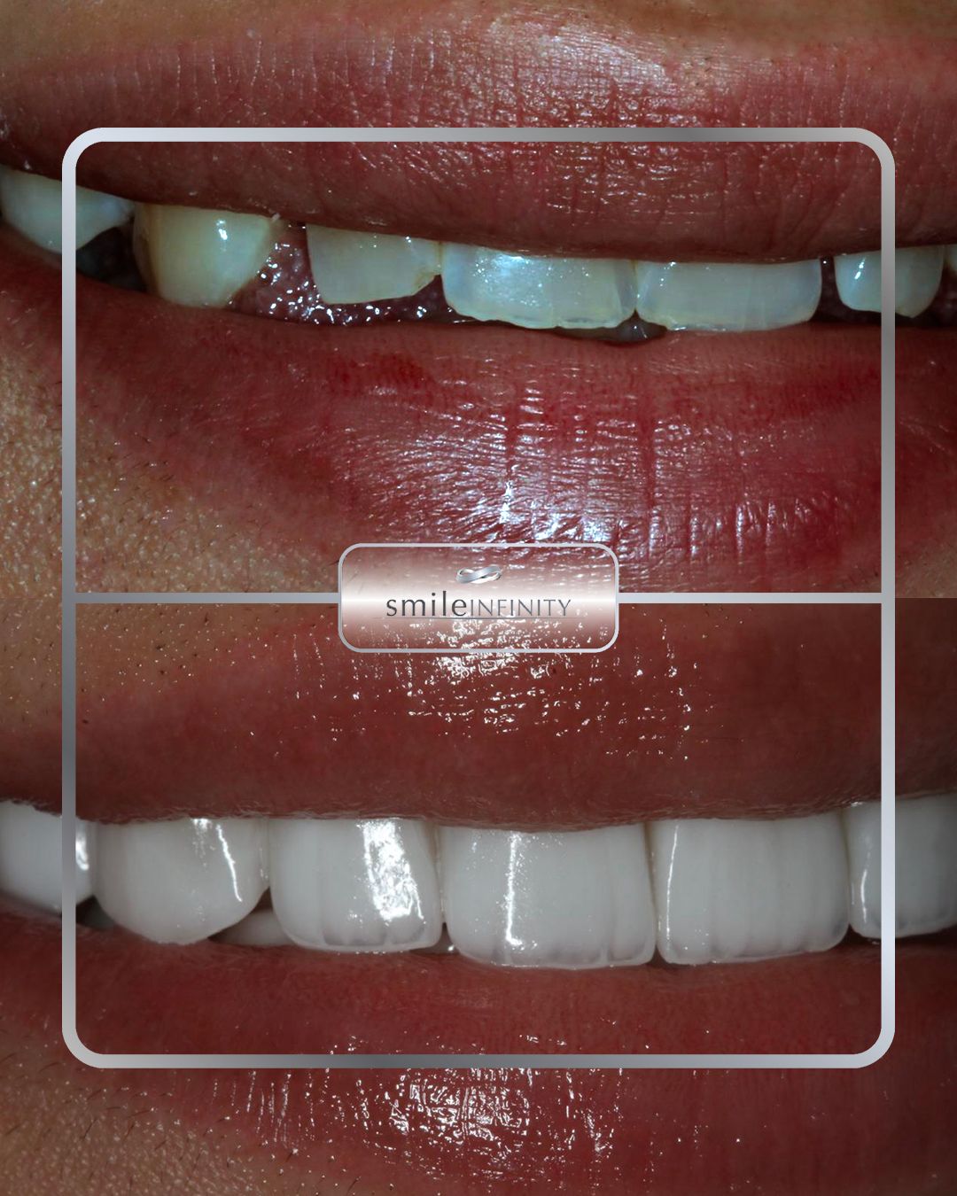Hollywood smile with porcelain veneers by Dr. Habib Zarifeh, Beirut Lebanon