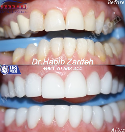 lumineers case by Dr. Habib Zarifeh