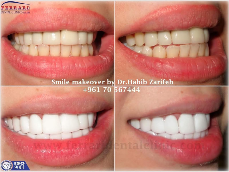 lumineers By Dr. Habib Zarifeh - Beirut, Lebanon