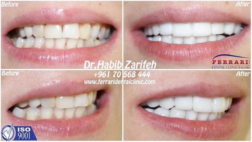 lumineers case by Dr. Habib Zarifeh