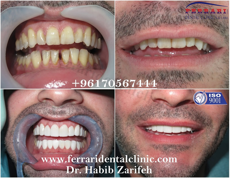 Veneers case by Dr. Habib Zarifeh