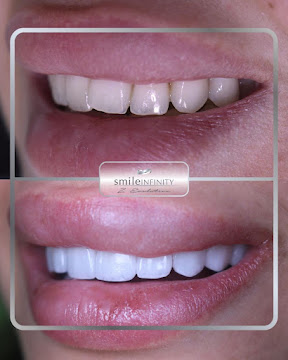 Porcelain veneers before and after Hollywood smile, Lebanon