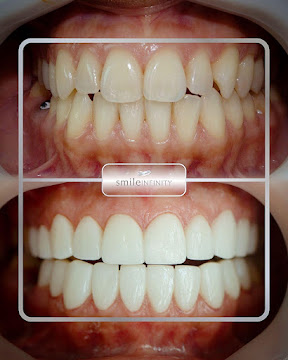 Digital smile design mock-up before veneers, Dr. Habib Zarifeh