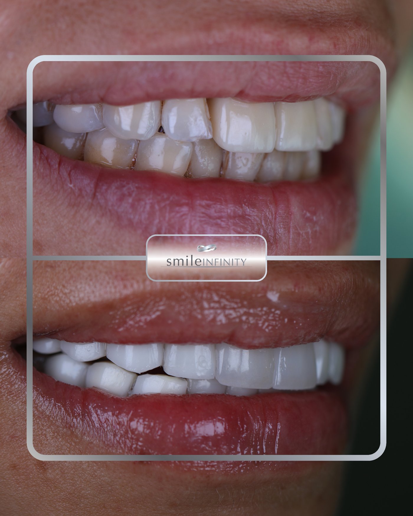 Natural porcelain veneers result, Smile Infinity by Dr. Habib Zarifeh