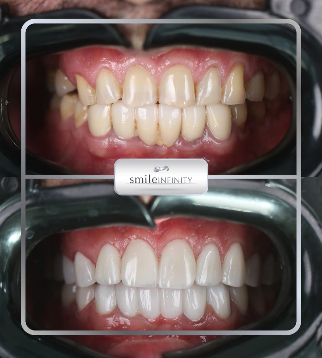 Porcelain veneers bonded with Ultra-Bond Plus DenMat, Beirut