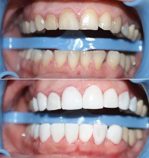 Veneers in Lebanon